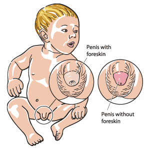 When Your Child Has Phimosis